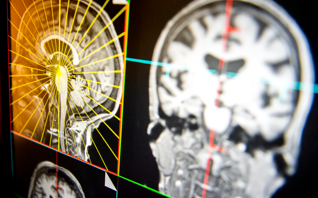 Could brain scans of children predict teenage mental illness?